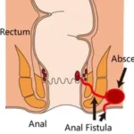 pengobatan fistula ani